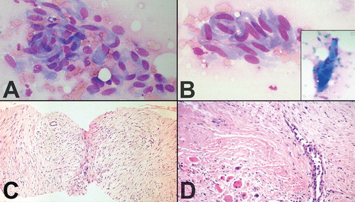 A and B: Fine-needle aspirates of desmoid tumors showing coherent clusters of uniform spindle cells with abundant cytoplasm and oval-to-elongated nuclei with evenly distributed chromatin. Large, basophilic multinucleate cells representing atrophic muscle fibers were frequently seen (panel B, insert). May-Grünewald Giemsa stain. C and D: Core needle biopsies of desmoid tumors showing the characteristic histological features, including evenly distributed fibroblastic tumor cells enclosed in a collagenous matrix, medium-sized angulated vessels and enclosure of atrophic muscle fibers (panel D, bottom left).