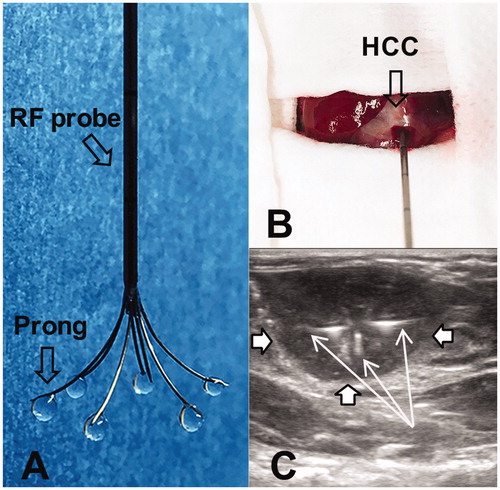Figure 1. (A) The photograph shows the multi-functional perfusion-thermal electrode, with multi-prongs for delivery of oncolytic viruses and thermal energy simultaneously. (B) The RF electrode is positioned in the center of a rat hepatic HCC (open arrow) under ultrasound guidance. (C). Oncolytic viruses are locally delivered into the tumor margin through the infusion prongs (arrows), where RF hyperthermia is simultaneously generated to further enhance the uptake of oncolytic viruses by the HCC (open arrows) cells.