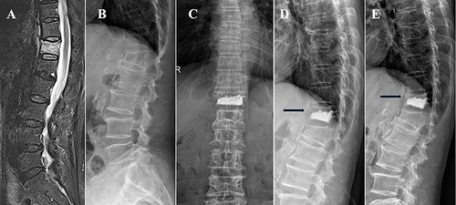 Figure 4 A 65 years old female patient with T12 vertebra compression fracture underwent PCVP. (A) T2 fat suppression MRI showed a fresh compression fracture of T12; (B) preoperative lateral fluoroscopy; (C and D) anteroposterior and lateral fluoroscopy 1 day post operation showed that the cement did not contact the upper endplate (black arrow); (E) The X-ray at 1 month post operation showed the uncemented portions of treated vertebra recollapsed and refracture occurred (black arrow).