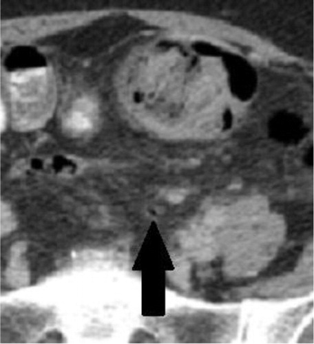 Fig. 2 Magnified image depicting a single focus of free air within the peritoneal cavity indicative of perforation. Peri-colonic infiltrative changes are also seen.