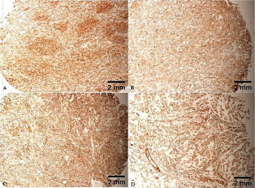 Figure 7. Cytoplasmic expression is noted in TNBCs with different morphology, including classic (A), cords-like (B), spindle (C) and single cell arrangements (D). Scale bar = 2 mm for panels A–D.