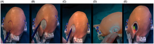 Figure 7. Phase I of the experimental evaluation. Phase II: Augmented reality guided incision of the skin and craniotomy. A) The surgeon marks with a pen the path of the skin incision on the skin following on the augmented reality path (red). B) Scalpel incision. C) After removing the skin incision path, the craniotomy perimeter is displayed and marked with a pen. D) Osteotomy drilling. E) Osteotomy completed: behind the exposed surface of the brain, the surgeon can perceive the position of the target lesion and of the surrounding eloquent area.