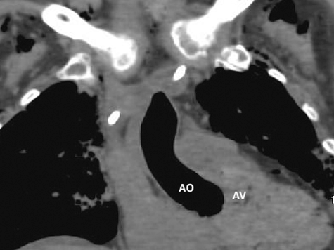 Figure 3. Coronal CT – lung windows – large amount of abnormal air in ascending aorta (AO). Aortic valve (AV) is delineated nicely demonstrated due to surrounding air.