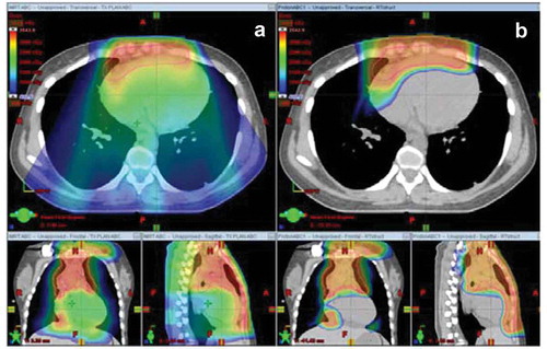 Figure 1. Colorwash dose distribution for a patient with bulky anterior mediastinal disease that draped over the heart. Panel A demonstrates the dose distribution with free-breathing intensity-modulated radiotherapy and panel B demonstrates free-breathing proton therapy. Reprinted from Hoppe BS, Mendenhall NP, Louis D, Li Z, Flampouri S. Comparing Breath Hold and Free Breathing during Intensity-Modulated Radiation Therapy and Proton Therapy in Patients with Mediastinal Hodgkin Lymphoma. Int J Part Ther. 2017 Spring;3(4):492-496. doi: 10.14338/IJPT-17-00012. Epub 2017 Jul 11. PubMed PMID: 31772999; PubMed Central PMCID: PMC6871555.