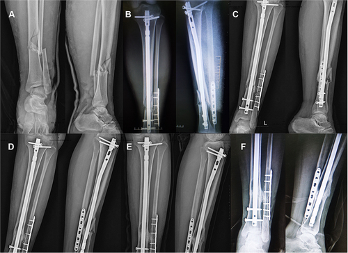 Figure 4 Anteroposterior and lateral X-ray films of a 20-year-old female patient with comminuted fracture of the left tibial. (A) Before surgery. (B) Immediately after surgery. (C) 1 month after surgery. (D) 3 months after surgery. (E) 6 months after (F) 12 months after surgery.