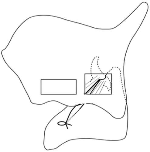 Figure 2. Schema of the fenestration approach. Arytenoid adduction (AA) is performed through the fenestration on the thyroid ala. The suture is pulled in the direction of lateral cricoarytenoid muscle (LCA) contraction and fixed to the cricoid cartilage.