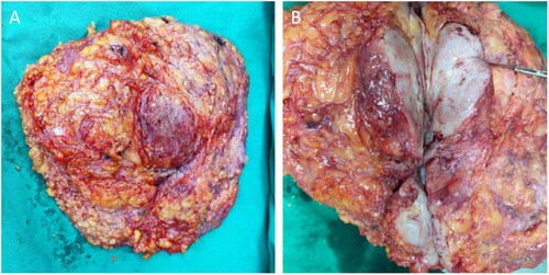 Figure 3. The gross specimen of the left breast excised during the surgery. Multiple tumors of different sizes can be observed (A). When the tumors were cut open, their surface was gray and fresh (B).