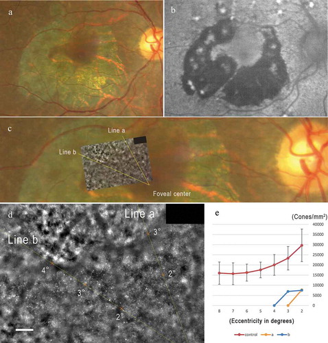Figure 7. High-resolution multimodal image analysis including adaptive optics images of the patient