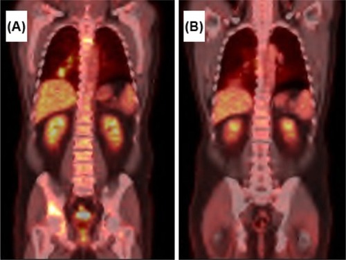 Figure 1 PET–CT scan of patient 1.