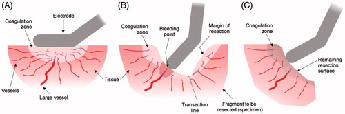 Figure 1. Creation of large coagulation zones using monopolar thermal coagulation could minimise intraoperative blood loss throughout different stages of liver resection: initial coagulation of the vessels located in zone to be transected (A), coagulation of vessels on the margin of resection during the transection (B), and preventive coagulation of the remaining resection surface (C).