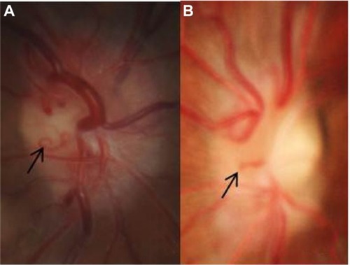 Figure 2 Fundus photograph showing generalized optic disc edema with optociliary shunt vessels (black arrows) in case 1 (A) and case 2 (B).