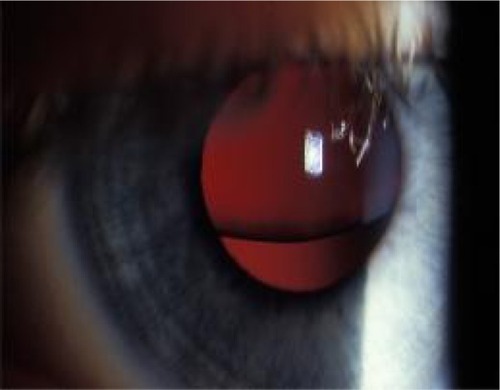 Figure 6 Subluxated lens in a child with Marfan’s syndrome.