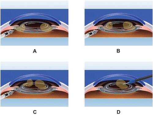 Figure 3 (A) It is difficult to remove the residual cortex which is trapped in the space between the CTR and the capsular equator. (B) Flush creates the current under the IOL. (C) Performing flush, the residual cortex is lifted up to the anterior chamber and convenient in aspirating. (D) After that, we can easily remove the residual cortex with ordinary I/A.