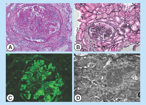 Figure 1.  Renal biopsy images.(A&B) Light microscopy of sections of renal cortex and medulla with active cellular and fibrocellular crescents. Frequent spike formation and segmental subendothelial deposits are seen. (C) Direct immunofluorescence of the renal cortex shows glomeruli with granular staining in the mesangial and capillary walls for IgG, IgA, IgM, C3, C1q, kappa and lambda light chains. (D) Electron microscopy of a glomerulus exhibiting immune-type electron-dense deposits in the subepithelial, intramembranous and mesangial locations. Glomerular basement membranes are irregularly thickened and distorted by the deposits.
