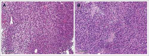 Figure 2. Histological comparison between patient original tumors and a PDOX tumor. (A) H&E staining of the patient original tumor and (B) untreated PDOX tumor. Scale bars: 100 μm.