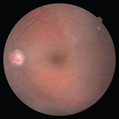 Figure 2. Fundus photo showed subtotal cupping of the optic disc due to glaucoma.