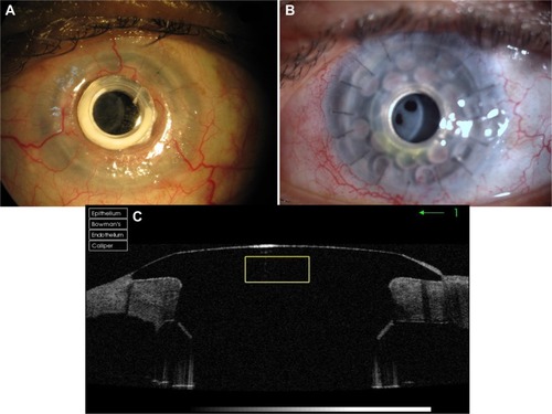 Figure 5 Postoperative course of the Boston type-1 KPro.