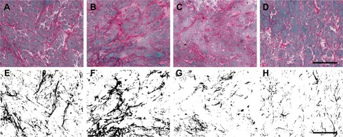 Figure 5 Sirius red staining and quantitative analysis of collagen fiber bundle of orthotopic MIA PaCa-2 tumors after treatment.Notes: (A–D) Representative Sirius red staining of tumor sections from treated and untreated groups and (E–H) the extracted collagen bundles from corresponding images, which revealed fewer collagen bundles in ATF-CNIO-CDDP treated tumors. The scale bar is 50 μm. (I) Relative collagen contents of tumors treated with different CDDP formulations which were estimated based on analysis of semiautomatic segmentation of the collagen bundles stained from corresponding images of Sirius red stained tumor sections. *P<0.05, **P<0.01.Abbreviations: ATF, amino-terminal fragment; CDDP, cisplatin; CNIO, milk protein (casein)-coated magnetic iron oxide.