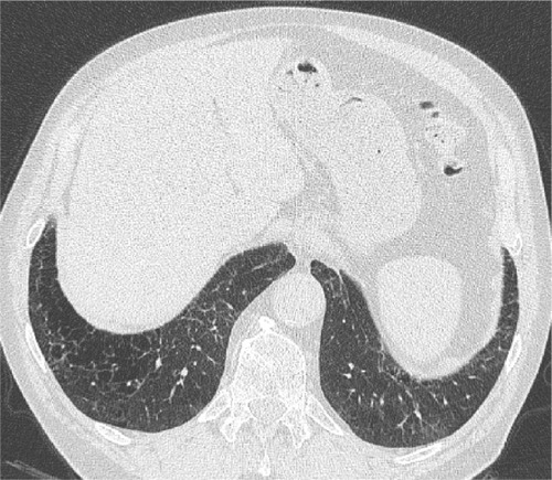 Figure 5 An axial LDCT image of a 79-year-old former male smoker with clinical COPD showing thick-walled, bizarre-shaped emphysematous areas in the right lower lobe that were regarded as consistent with AEF.Abbreviations: LDCT, low-dose computed tomography; AEF, airspace enlargement with fibrosis.