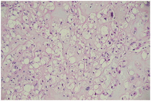 Figure 2. Light microscopy photograph of the tumor shows cords and lobules of vacuolated cells separated by fibrous septa with chondromyxoid stroma (Hematoxylin and eosin stain; ×100 and ×200).