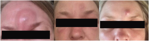 Figure 2. Progression after initiation of oral penicillin. Initially the forehead swelled, accompanied by generalized oedema of the face and the appearance of a red protrusion in the same area.