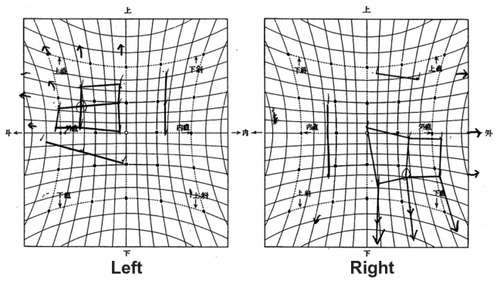 Figure 3C Hess screen chart before edrophonium chloride administration.