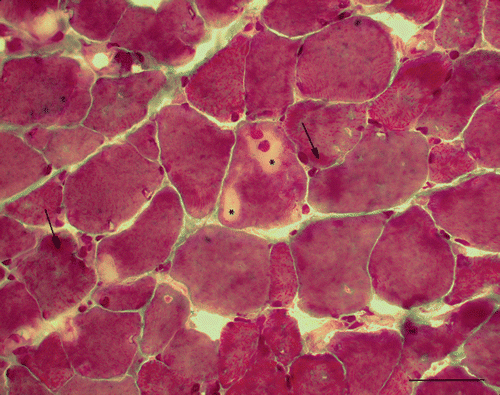 Figure 1. Gomori trichrome. Hyaline inclusions inside the myofibres (asterisks). Intensively stained spaces at the periphery of myofibres (arrows) (Bar 100 µm, 1st biopsy).