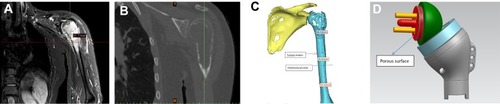 Figure 1 (A) A coronal contrast-enhanced T2-weighted MRI in a patient with Campanacci grade III GCT of bone; (B) a coronal CT scan images; (C) Based on the pre-operative CT and MRI data, the tumour extent and osteotomy position were outlined on a 3D computer model; (D) the design of the 3D-printed glenoid prosthesis and a personalized custom-made humerus prosthesis.Abbreviation: 3D, three-dimensional.