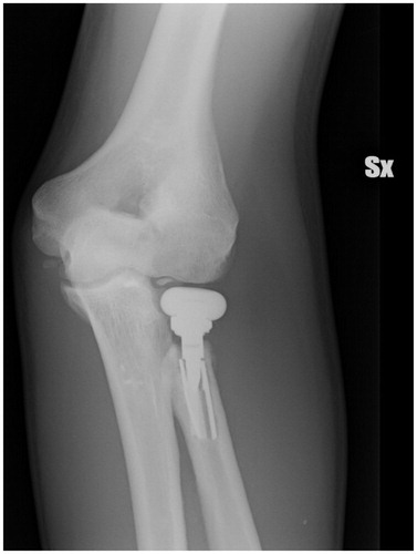 Figure 3. Rupture of the prosthetic stem.
