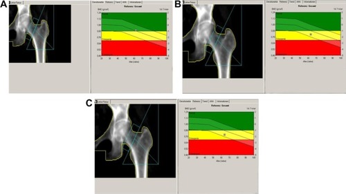Figure 2 Left femur bone mass density over time. (A) At baseline, (B) at 12 months, and (C) at 24 months.