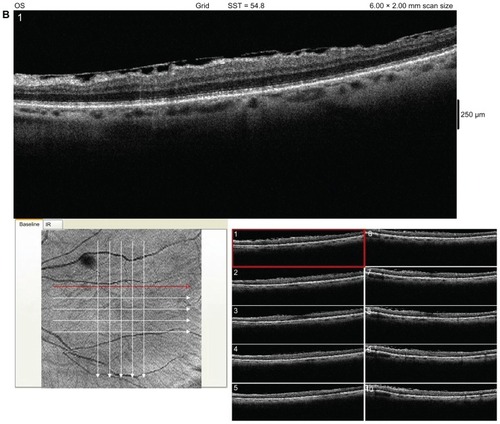 Figure 1 Posterior Segment Optical Coherence Tomography (OCT) of the left eye revealing an epiretinal membrane.
