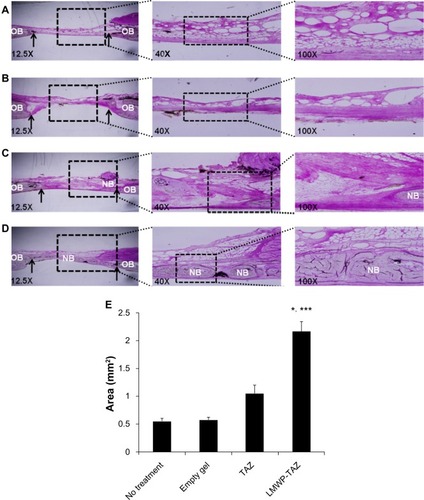 Figure 6 (A–E) Histological evaluation of LMWP-TAZ fusion protein assembled alginate gel matrix in rabbit calvarial defects after 4 weeks’ implantation with hematoxylin and eosin staining.Notes: (A) No-treatment group (original magnification 12.5×, 40×, 100×), (B) empty alginate gel-treated group (original magnification 12.5×, 40×, 100×), (C) TAZ protein-loaded alginate gel-treated group (original magnification 12.5×, 40×, 100×), (D) LMWP-TAZ fusion protein-loaded alginate gel-treated group (original magnification 12.5×, 40×, 100×). Bone margin is indicated by an arrow. (E) Histomorphometric result at 4 weeks. Total new bone is expressed as area (mm2). *P<0.05 compared to time-matched empty defect; ***P<0.05 compared to time-matched TAZ-treated group.Abbreviations: OB, old bone; NB, new bone; LMWP, low-molecular-weight protamine; TAZ, PDZ-binding motif.