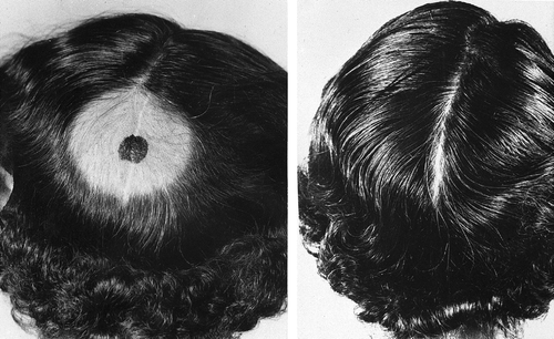 Figure 10.  Demonstration of the epilation caused by 131I treatment of a metastasis in the skull (left panel). The right panel shows later regrowth of hair.