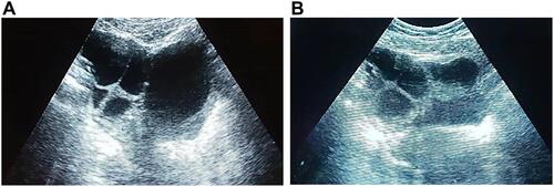 Figure 1 (A) Right ovary transverse ultrasound image shows enlarged right ovary with multiple cysts of various size consistent with ovarian hyperstimulation. (B) Left ovary transverse ultrasound image shows enlarged left ovary with multiple cysts of various size consistent with ovarian hyperstimulation.