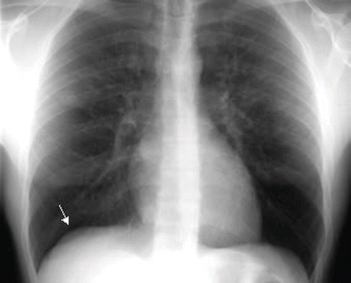 Fig. 1.  Chest x-ray in upright position, showing the presence of free air under the inter-hepatic-diaphragm at the base of the right lung (Jobert sign).