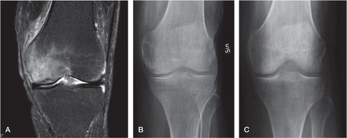 Figure 1. A. A 59-year-old man had sudden onset of knee pain and was diagnosed with osteonecrosis by MRI. B. There were no or discrete signs of osteonecrosis in the plain radiographs. Alendronate was given for 6 months and the pain disappeared. C. Radiograph after 1 year. Radiographically, no signs of osteonecrosis ever appeared.