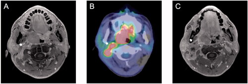 Figure 1. Oropharyngeal carcinoma with bilateral multiple cervical lymph nodes (LNs) and ipsilateral retro-styloid lymph node metastasis (RSLNM). (A) Contrast-enhanced fat-saturated eTHRIVE and (B) [18F]-fluoro-2-deoxy-d-glucose-positron emission tomography/computed tomography fused images show the presence of RSLNM (arrow; longest diameter = 14 mm, SUVmax=4.1). (C) Contrast-enhanced fat-saturated eTHRIVE images. The longest diameter of LN in the upper limit of ipsilateral level II was 27 mm (arrow).
