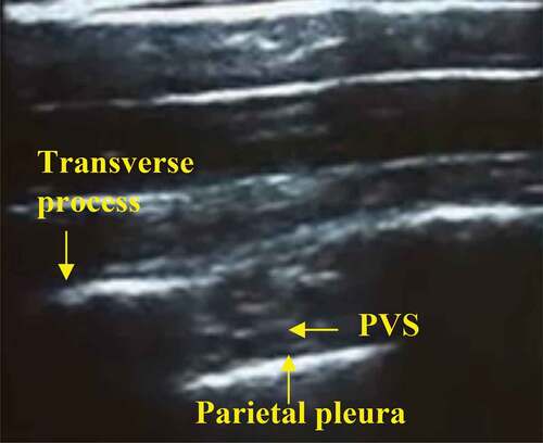 Figure 1. Ultrasonographic identification of landmarks including transverse process and parietal pleura in one image with PVS inbetween