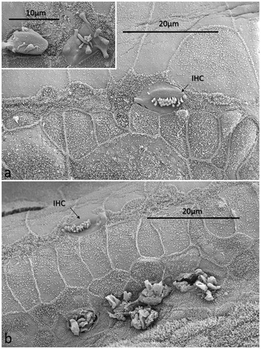 Figure 6. FESEM of the ‘hook’ region of the human cochlea. This region was generally devoid of hair cells. Image a: There is a solitary IHC with short stereocilia. Scarring of the reticular lamina is present. The inset shows two degenerated IHCs. Image b: A solitary IHC can be observed. The inner pillar heads appear preserved, whereas degenerated OHCs are observed below. Reparative processes or sIHCs are not apparent (patient 1).