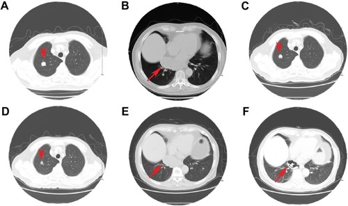 Figure 2 Chest CT images showing metastases before (A and B) and after treatment with apatinib (C, D and E, F, respectively).