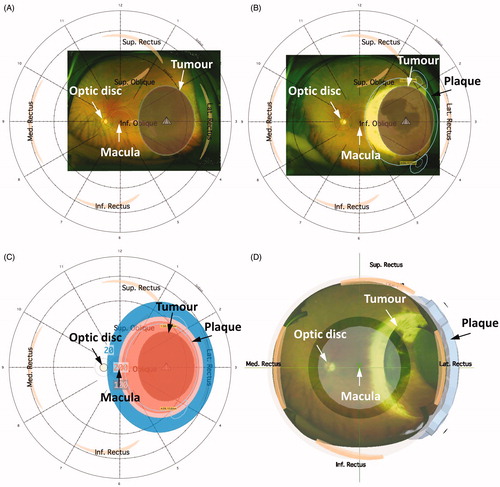Figure 1. 3D image-guided planning using Plaque Simulator. (A) Recreated tumour position and relative distances to the macula and the optic disc on pre-treatment fundus photography. (B) Retrospectively recreated plaque position based on radiation scar on post-treatment fundus photography. (C) 3D dose distributions were recreated based on the exact treatment time extracted for each patient. The 200 Gy, 100 Gy, and 20 Gy isodose lines are shown. (D) 3D illustration of the recreated treatment plan showing plaque position, the tumour, macula, and optic disc. An anterior view was chosen for illustration purposes.