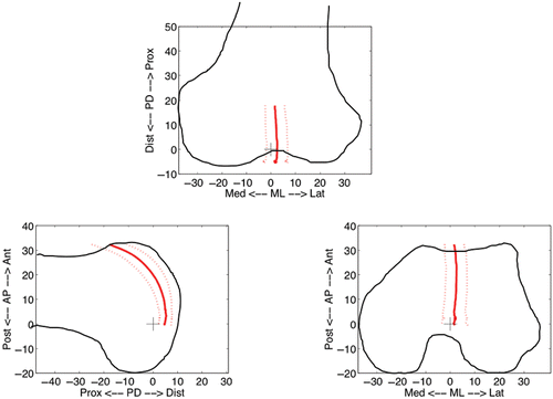 Figure 5. The pre-arthroplasty patellar trajectory (mean and standard deviations) had minimal mediolateral deviation throughout flexion. Geometric data for the femurs were obtained intraoperatively by matching digitized portions of the femoral surface to a statistical shape model. The schematic shows a typical femoral shape. [Color version available online.]