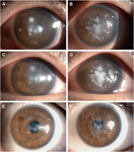 Figure 5 An 18-year-old man with several dense white infiltrates in the central cornea 4 days after SMILE in the right eye, and the infiltrates were more serious than before (A). The left eye showed multiple white infiltrates at the corneal cap–stromal bed interface (B). At 5 days after SMILE, the incision was enlarged to more than 2 quadrants, and the corneal cap was opened to fully scrape the infiltrates and rinse with antibiotics. The right eye improved 2 days later (C), but as the infiltrates worsened in the left eye (D), irrigation of the corneal cap–stromal bed interface in the left eye was repeated. At 6 months after the onset, the cornea has residual stromal scarring, and the vision improved from light perception to 20/25 in the right eye (E) and 20/32 in the left eye (F).