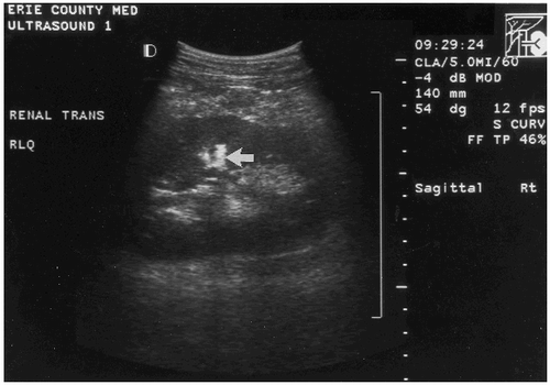Figure 1. Ultrasound performed 24 h post-renal transplantation. Arrow denotes stone in the renal parenchyma.