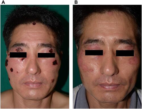 Figure 1 (A) Multiple pyodermic plaques with hemorrhagic eschar on the face. (B) The lesions cleared up leaving mild scarring 10 days later.