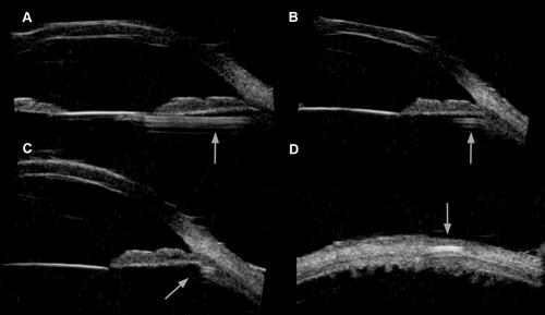 Figure 5 Clinical records of a representative patient at six months after surgery (case three) UBM images. The arrows indicate the haptic course in the posterior chamber and in the scleral tunnel. Note in particularly in (A) the prolene loop of the IOL in the posterior chamber, (B) the haptic entering the ciliary sulcus, (C) haptic in the ciliary sulcus, (D) the end of the prolene loop in the scleral tunnel.