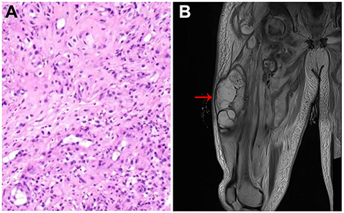 Figure 4 (A) H&E staining of L4–5 disc space tissues shows typical characteristics of acute and chronic inflammatory cell infiltration; (B) MRI image shows an obvious swelling (red arrow) in the patient’s thigh.