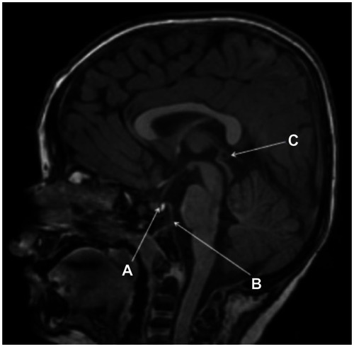 Figure 8 Sagittal FSPGR BRAVO image displaying a 4 mm pars intermedia pituitary cyst within an otherwise normal pituitary gland, a relatively steep clival angle, and a 4 mm pineal cyst is present. (A) A 4 mm pars intermedia pituitary cyst within an otherwise normal pituitary gland. (B) There is a relatively steep clival angle. (C) A 4 mm pineal cyst is present. Also note mild brachycephaly.