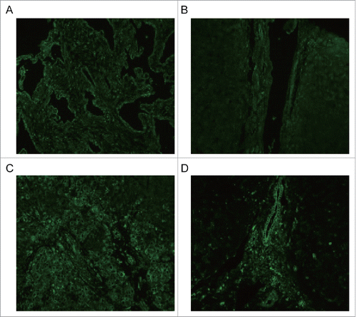 Figure 2. ETAR expression from tissue samples was visualized and localized by confocal microscopy. X: hepatic hemangioma; LC: liver cirrhosis; C: liver cancer; P: para-carcinoma.