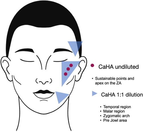 Figure 2 Treatment options for transgender facial feminization with CaHA.